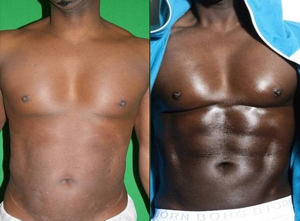 donovan-nelson-pec-implants-liposuction-3 donovan-nelson-pec-implants-liposuction-3