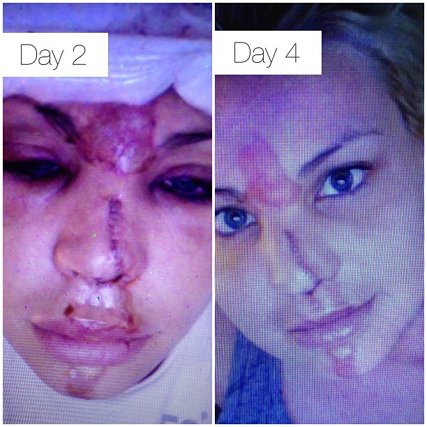 lisa-damato-face-accident-2